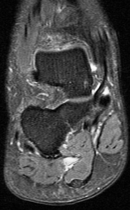 Figure 3 for case Juvenile plantar fibromatosis